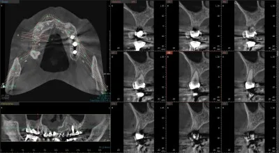 환자의 치과 CT 영상. 3D 재구성된 구강 내부와 여러 단면 이미지가 함께 표시되어 있으며, 임플란트 식립 계획이 시뮬레이션되어 있다.