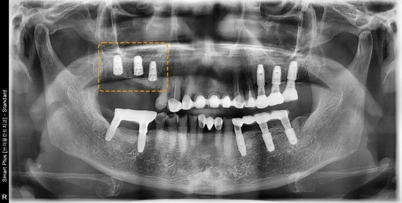 환자의 파노라마 방사선 사진. 상악 좌측 어금니 부위에 임플란트 4개가 식립된 모습이 주황색 점선으로 표시되어 있다.