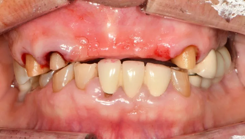 환자의 정면 구강 내 사진. 상악에 임시 보철물이 장착되어 있고, 잇몸에 발치 및 임플란트 식립 후 회복 중인 흔적이 보인다.