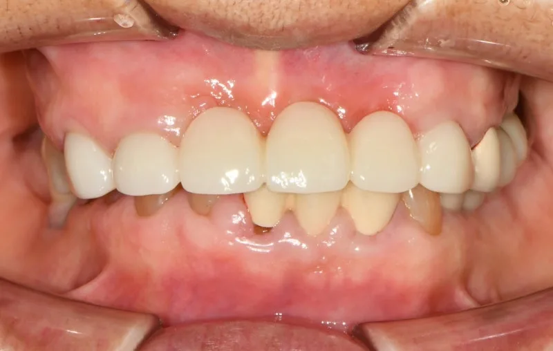 환자의 정면 구강 내 사진. 상악에 최종 보철물이 장착되어 있으며, 자연스러운 치아 형태와 색상을 보여준다.