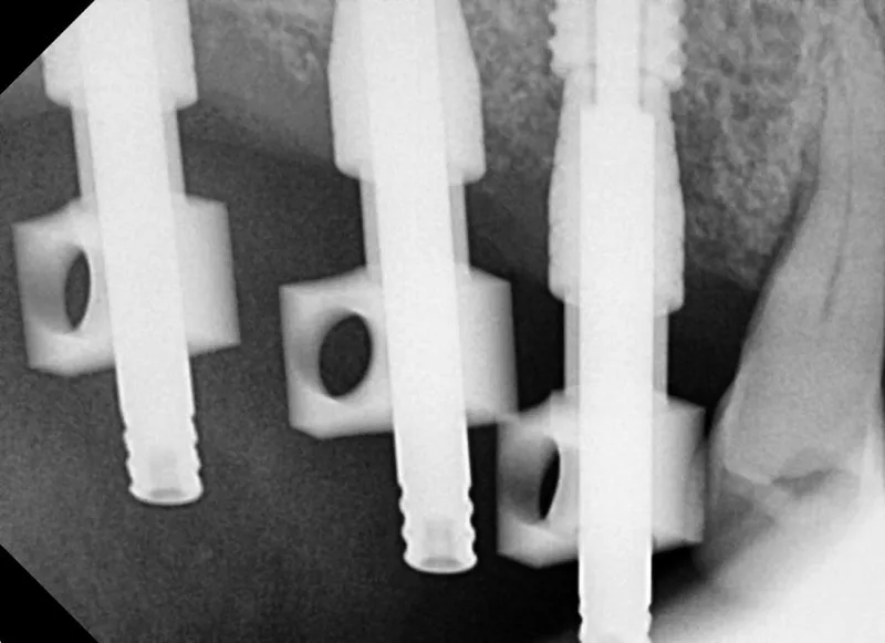 환자의 치근단 방사선 사진. 상악 좌측 어금니 부위에 식립된 임플란트 3개의 모습이 확대되어 보인다.