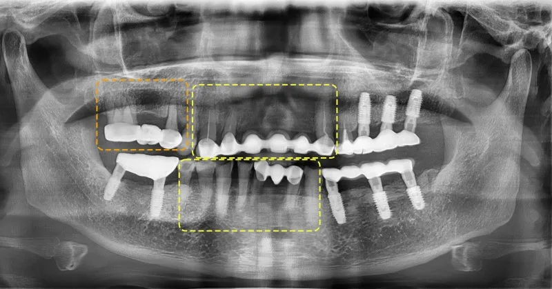 환자의 파노라마 방사선 사진. 상악과 하악에 임플란트 및 보철물이 보이며, 일부 영역이 주황색 점선으로 표시되어 있다.