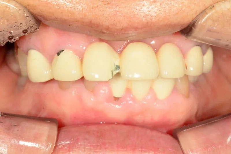 환자의 정면 구강 내 사진. 상악과 하악에 치아 보철물이 있으며, 일부 보철물에 손상된 부분이 보인다.