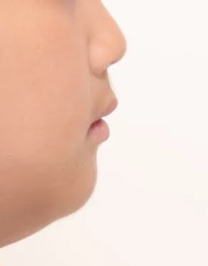 어린이의 측면 얼굴 사진. 아래턱이 정상적인 위치로 개선되어 보인다.