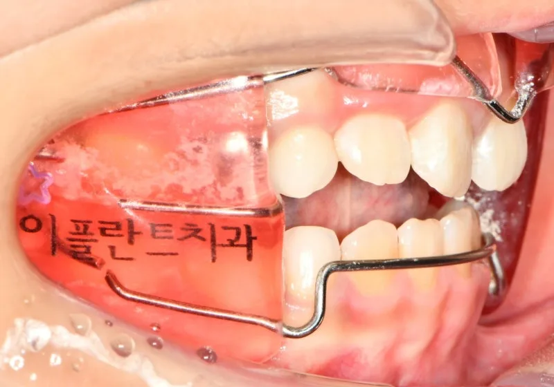 수성구치과 아이 주걱턱 교정, 언제 개입할까요? 관련 사진 23