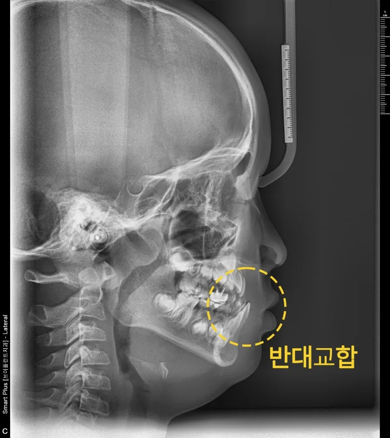 어린이의 측면 두부 방사선 사진. 노란색 점선 원으로 반대교합 부위가 표시되어 있다.