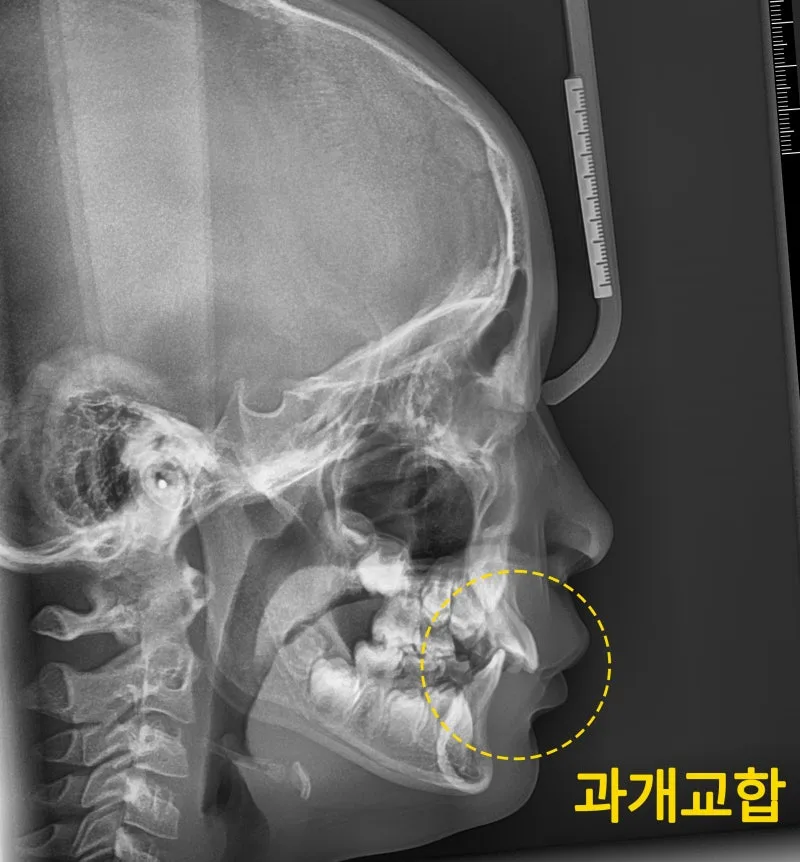 측면 두부 방사선 사진에서 과개교합 부위를 노란색 점선 원으로 표시한 모습