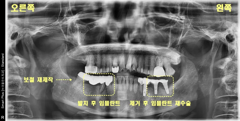 발치 후 임플란트와 임플란트 재수술 부위를 표시한 파노라마 방사선 사진