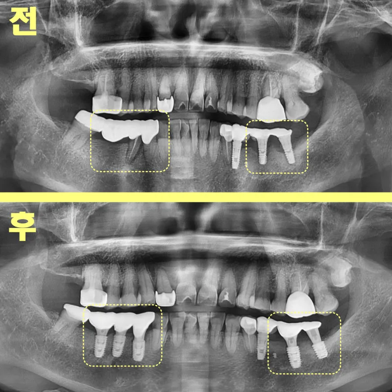 수성구치과 임플란트 재수술 순서가 중요합니다 관련 사진 21