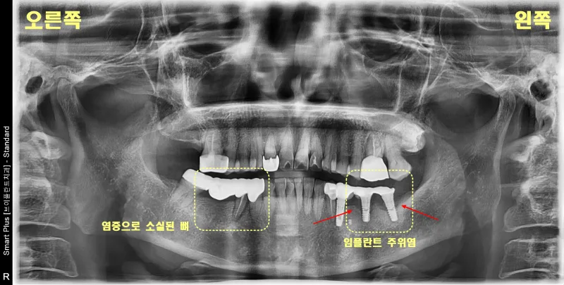 임플란트 주위염과 염증으로 소실된 뼈를 표시한 파노라마 방사선 사진