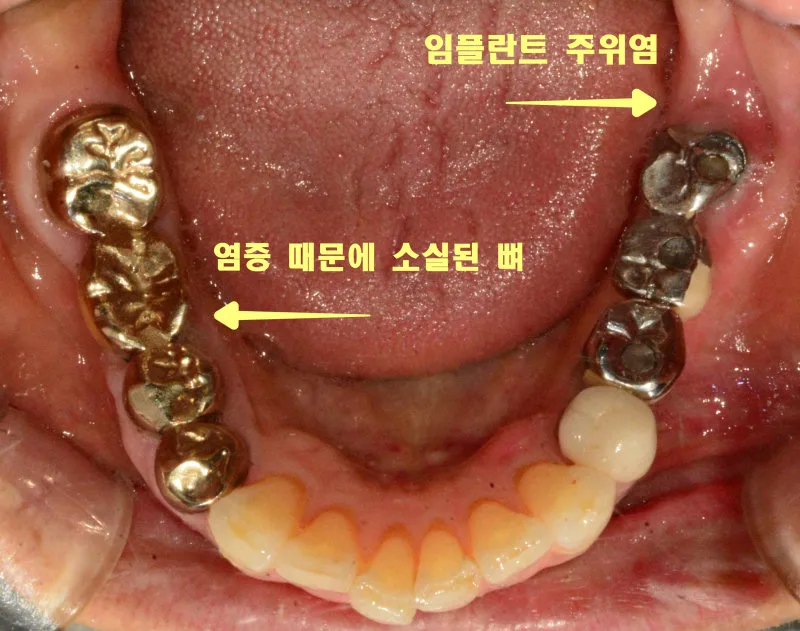 하악 치아에 금속 보철물과 임플란트 주위염, 염증으로 소실된 뼈를 표시한 구강 내 사진