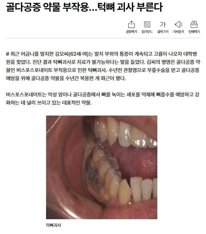 골다공증 약물 부작용으로 인한 턱뼈 괴사 관련 기사 이미지