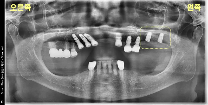 환자의 파노라마 방사선 사진으로 상악 좌측에 임플란트 식립된 모습