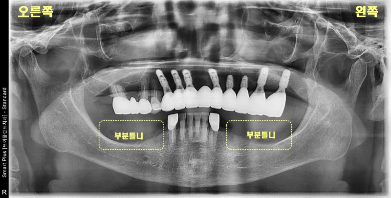 환자의 파노라마 방사선 사진으로 상악 임플란트와 하악 부분 틀니 유지 부위 표시