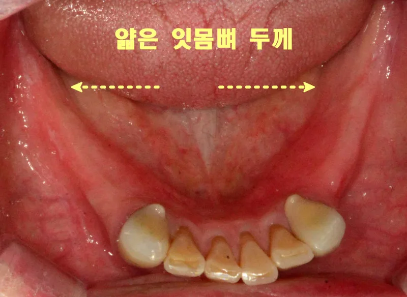 환자의 하악 치아의 설측면 구강 내 사진