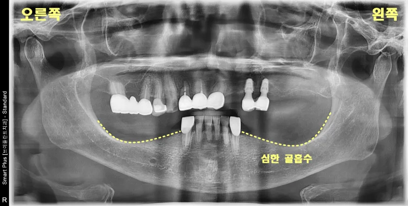환자의 파노라마 방사선 사진으로 하악의 심한 골흡수 표시
