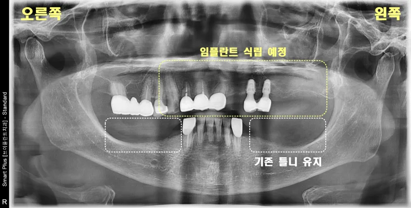 환자의 파노라마 방사선 사진으로 임플란트 식립 예정 부위와 기존 틀니 유지 부위 표시
