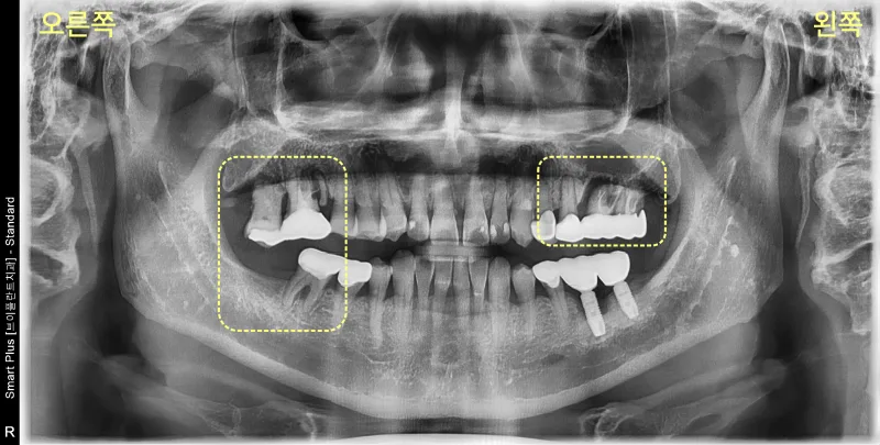 환자의 파노라마 방사선 사진. 상악 좌우 어금니 부위에 염증과 치아 손상이 노랗게 표시되어 있다.