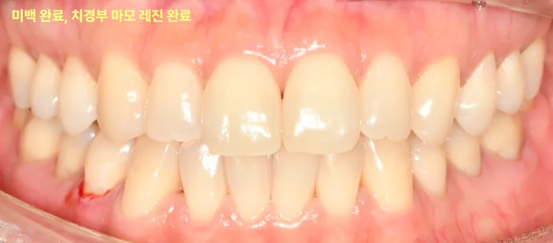 환자의 구강 내 치아 정면 사진. 치아 미백 완료 및 치경부 마모 레진 치료 후의 모습이다.