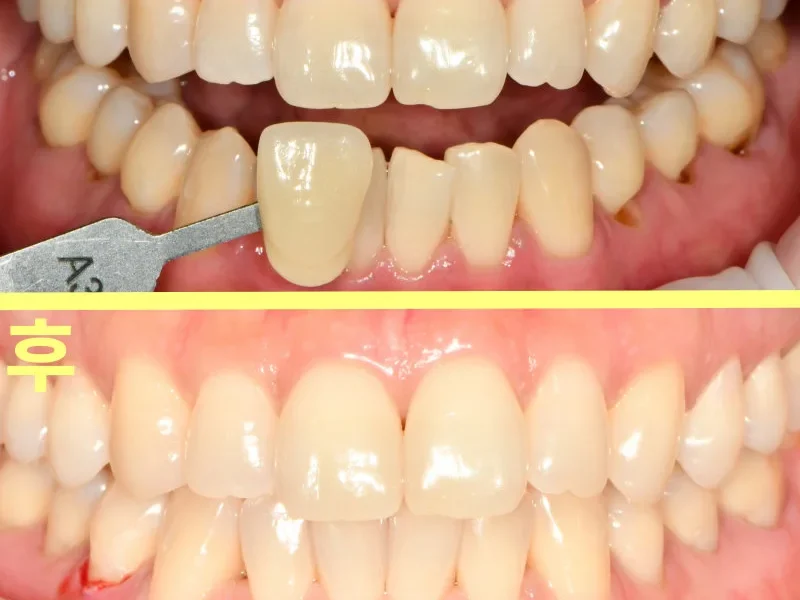치아 미백 전후 비교 사진. 상단은 미백 전 VITA shade guide A3 탭으로 색상을 측정하는 모습, 하단은 미백 후의 모습이다.
