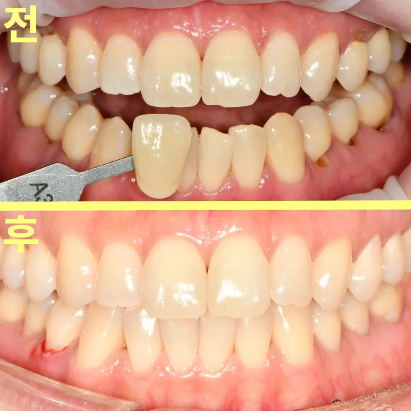 치아 미백 전후 비교 사진. 상단은 미백 전 VITA shade guide A3 탭으로 색상을 측정하는 모습, 하단은 미백 후의 모습이다.