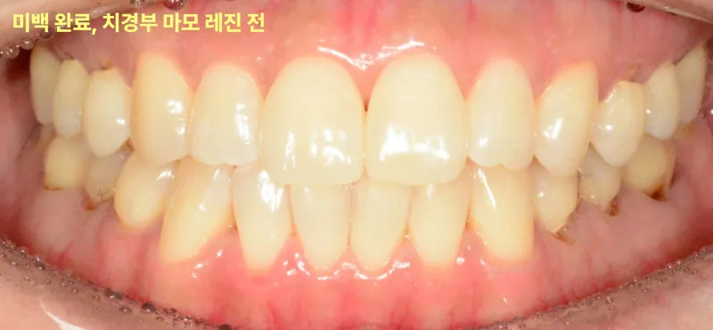 환자의 구강 내 치아 정면 사진. 치아 미백 완료 후 치경부 마모 레진 치료 전의 모습이다.